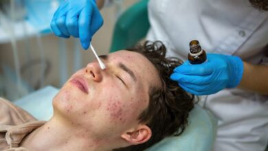 Acne Treatment in Kolkata