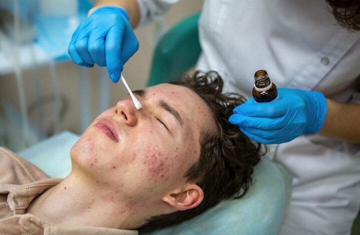 Acne Treatment in Kolkata