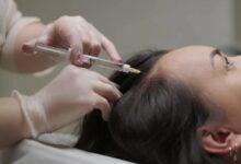 PRP Treatment for Hair Loss