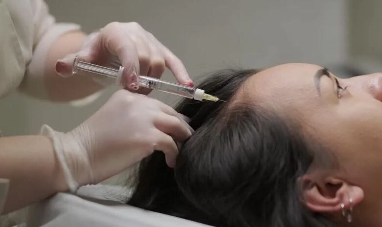 PRP Treatment for Hair Loss