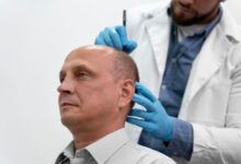 Hair loss solutions Chicago